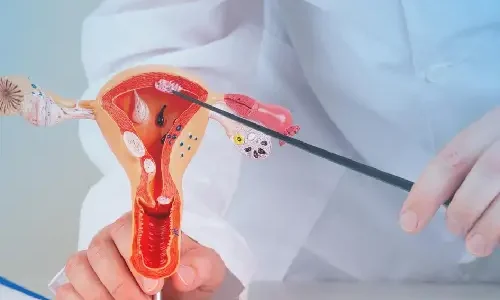 Uterus Removal