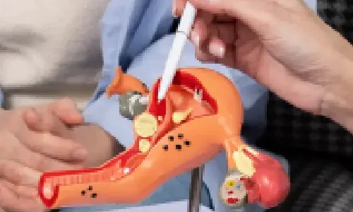 cyst removal