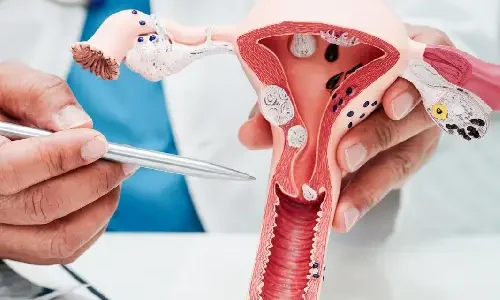 fibroids